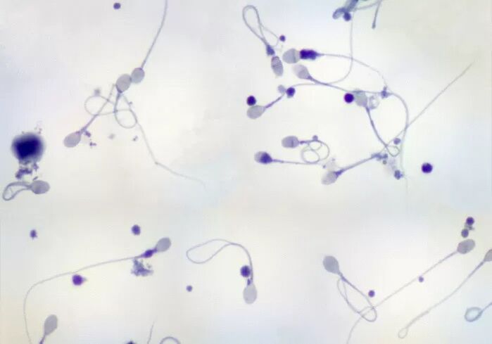 Diagnosticēta oligozoospermija – maz spermatozoīdu